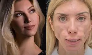 Porównanie: przed i po zabiegu liftingu twarzy nieudany. Po prawej stronie widać niepokojące zmiany.