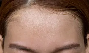 Skóra czoła z widocznymi porami i błyszczącym efektem, który może być spowodowany nadmiarem sebum. Co to jest sebum i jak sobie z nim radzić?