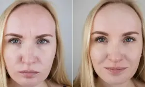 Przed i po mezoterapii igłowej: wygładzone zmarszczki na czole, poprawa tekstury skóry. Efekty po 1 zabiegu widoczne od razu.