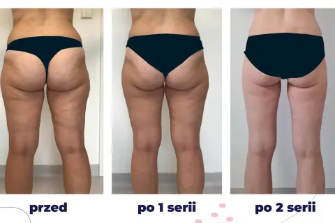 Przed i po kriolipolizie ud. Widoczne zmniejszenie cellulitu i poprawa jędrności skóry po 1 i 2 seriach zabiegu.
