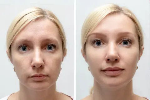 Przed i po zabiegu wampirzy lifting. Skóra twarzy wygładzona, zmarszczki zredukowane, cera promienna.