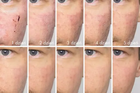 Dermapen efekty: skóra po zabiegu od 1 do 10 dnia. Widoczna regeneracja i poprawa wyglądu cery.