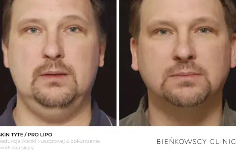 Przed i po zabiegu lipolizy iniekcyjnej. Widoczna redukcja tkanki tłuszczowej i obkurczenie skóry podbródka.