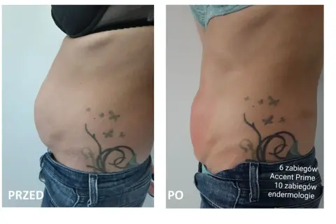 Przed i po zabiegu liposukcja kawitacyjna. Widoczna redukcja tkanki tłuszczowej na brzuchu po 1 zabiegu.