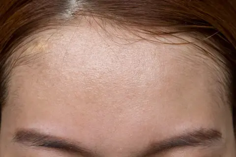 Skóra czoła z widocznymi porami i błyszczącym efektem, który może być spowodowany nadmiarem sebum. Co to jest sebum i jak sobie z nim radzić?