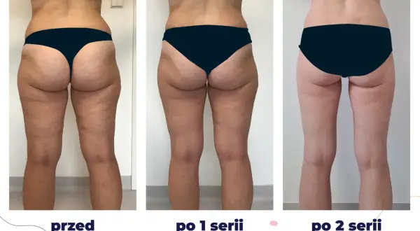 Przed i po kriolipolizie ud. Widoczne zmniejszenie cellulitu i poprawa jędrności skóry po 1 i 2 seriach zabiegu.