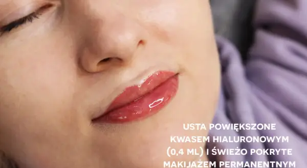 Usta po powiększeniu kwasem hialuronowym i makijażu permanentnym. Pełne, błyszczące wargi z subtelnym kolorem.