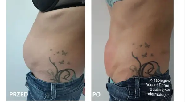 Przed i po zabiegu liposukcja kawitacyjna. Widoczna redukcja tkanki tłuszczowej na brzuchu po 1 zabiegu.