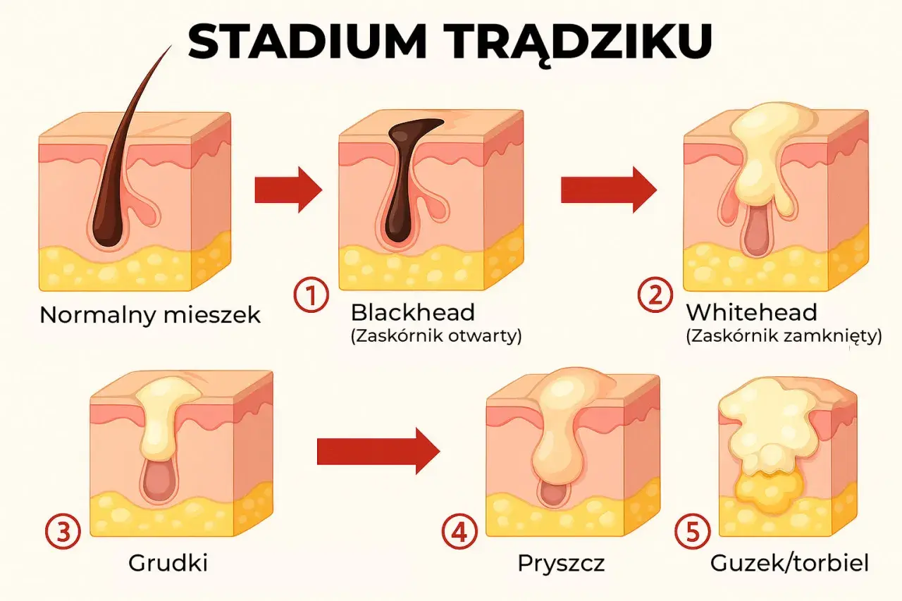 Ilustracja pokazuje etapy powstawania wyprysków na twarzy: od normalnego mieszka włosowego, przez zaskórniki, grudki, pryszcze, aż do guzków/torbieli.