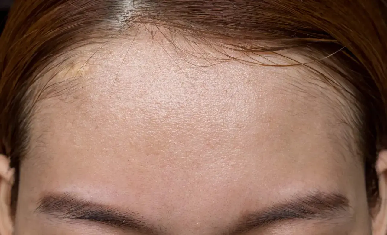 Skóra czoła z widocznymi porami i błyszczącym efektem, który może być spowodowany nadmiarem sebum. Co to jest sebum i jak sobie z nim radzić?