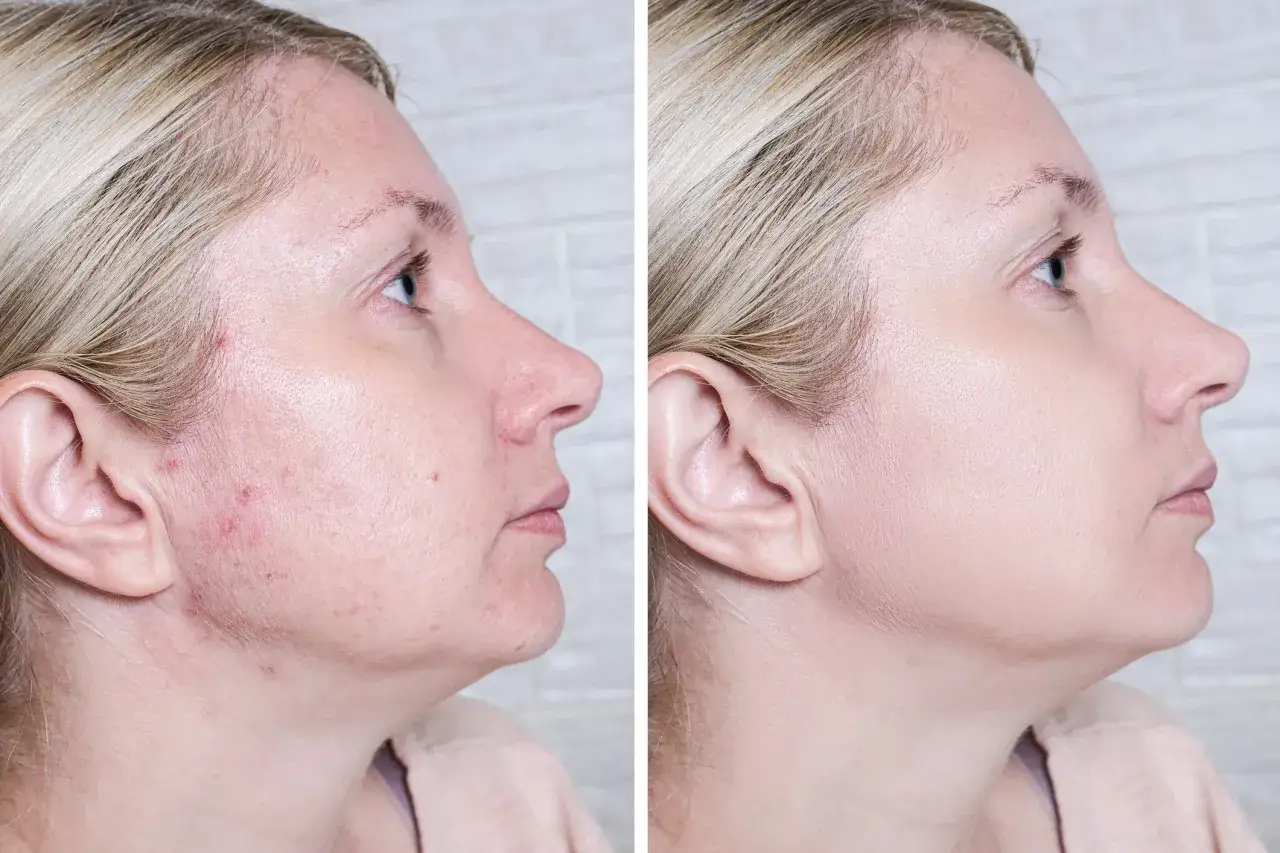 Przed i po: skóra z niedoskonałościami i zaczerwienieniami po zastosowaniu Acne Derm. Efekty widoczne na twarzy.