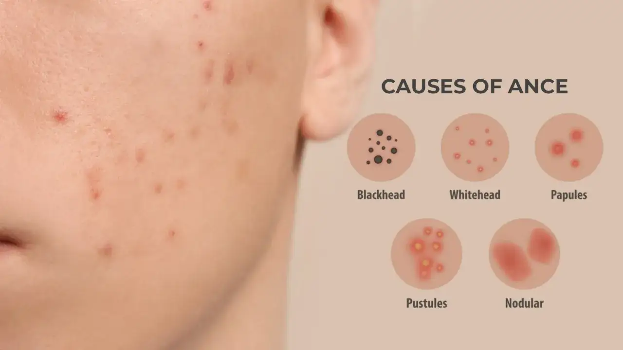 Ilustracja pokazuje różne rodzaje trądziku: zaskórniki, białe krostki, grudki, ropne krosty i guzki.