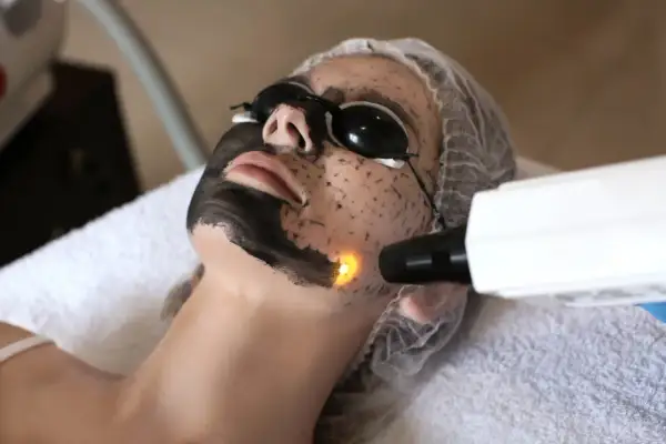 Kobieta w okularach ochronnych poddaje się zabiegowi peelingu węglowego. Laser skierowany na twarz, gdzie widać czarną maskę.