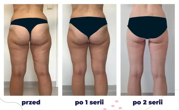 Przed i po kriolipolizie ud. Widoczne zmniejszenie cellulitu i poprawa jędrności skóry po 1 i 2 seriach zabiegu.