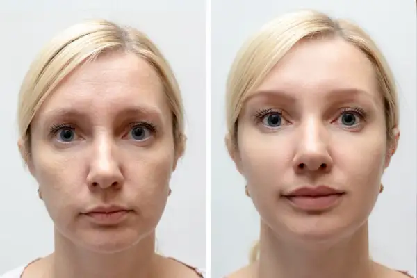 Przed i po zabiegu wampirzy lifting. Skóra twarzy wygładzona, zmarszczki zredukowane, cera promienna.