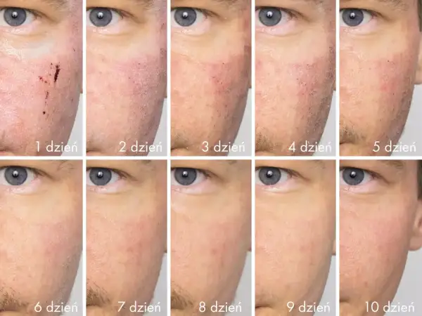 Dermapen efekty: skóra po zabiegu od 1 do 10 dnia. Widoczna regeneracja i poprawa wyglądu cery.