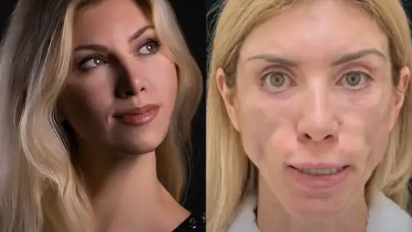 Porównanie: przed i po zabiegu liftingu twarzy nieudany. Po prawej stronie widać niepokojące zmiany.