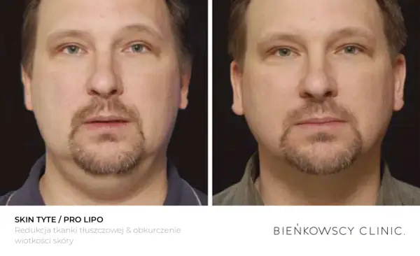 Przed i po zabiegu lipolizy iniekcyjnej. Widoczna redukcja tkanki tłuszczowej i obkurczenie skóry podbródka.