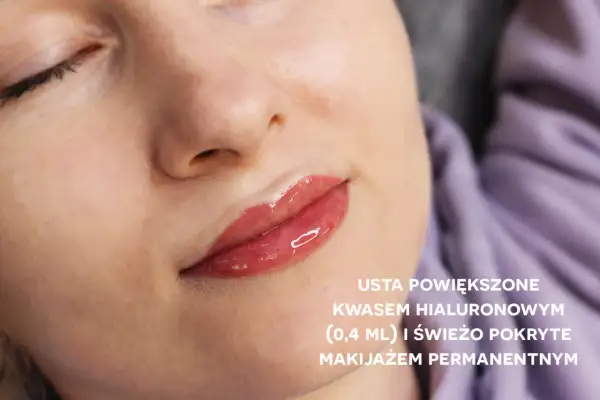 Usta po powiększeniu kwasem hialuronowym i makijażu permanentnym. Pełne, błyszczące wargi z subtelnym kolorem.