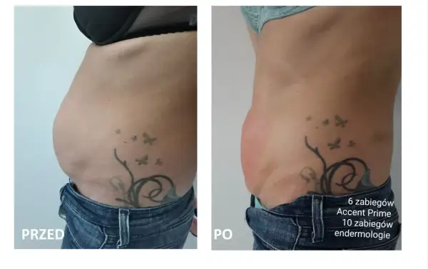 Przed i po zabiegu liposukcja kawitacyjna. Widoczna redukcja tkanki tłuszczowej na brzuchu po 1 zabiegu.